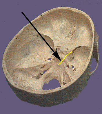 Cranium CN VI