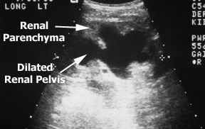 kidney ultrasound hydronephrosis