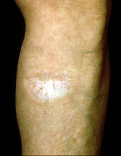  Atrophy: Loss of substance of Skin. Thinning of epidermis, dermis or 
