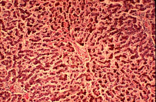 causes of retropharyngeal cellulitis