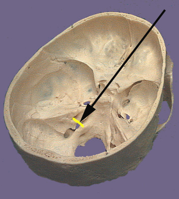 Cranium CN VIII