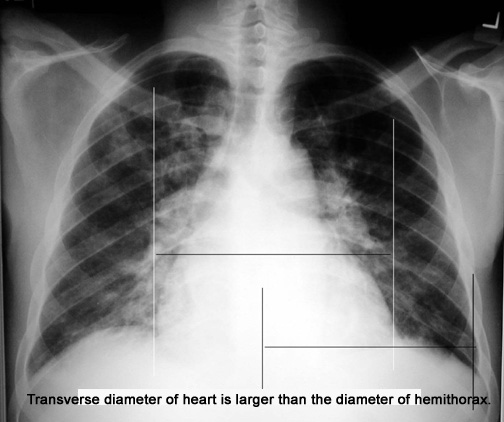 Q2: Anticipated findings in Chest x-ray in a patient with congestive heart 