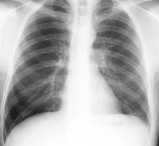 Pleura l effusion seen in an ultra sound image as in one or more fixed pockets in the pleural space is said to be loculated pleural effusion.in us scan us scan they can be identified clearly and it is very complicated.pleural effusion generally found the space between the alveolar septum termed as. New Page 1 www.meddean.luc.edu