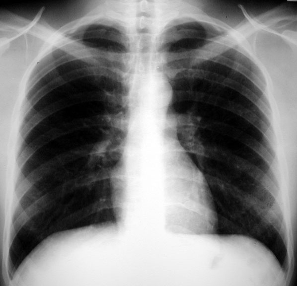Stomach cancer