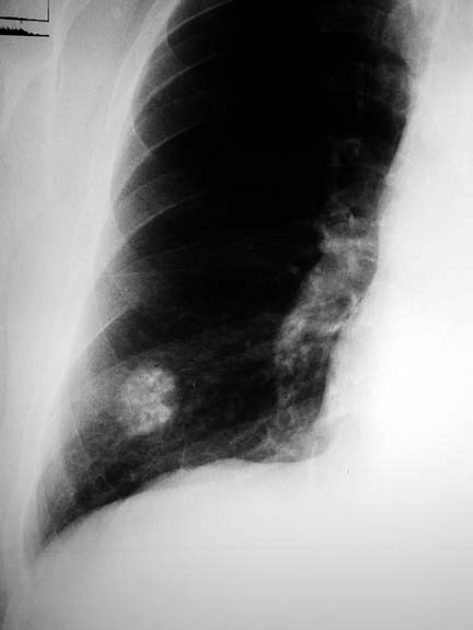 Solitary Pulmonary Nodule
