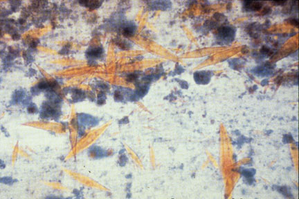 Charcot Leyden Crystals