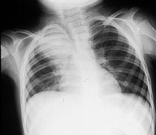 the entire lobe or lung. lobes of lungs. the entire lobe or lung.