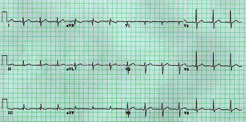 ekg58.JPG (38758 bytes)