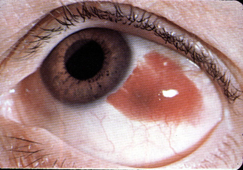 Subconjunctival hemorrhage: Sharply demarcated red area , may involve the 