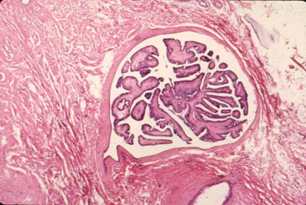 http://www.meddean.luc.edu/lumen/MedEd/Pathology/images/breast05.jpg