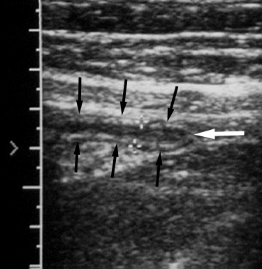 Ultrasound Appendicitis