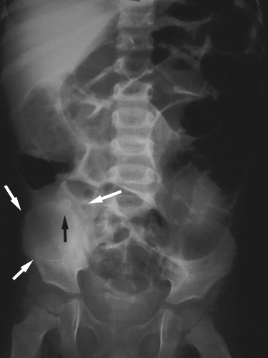 right iliac fossa