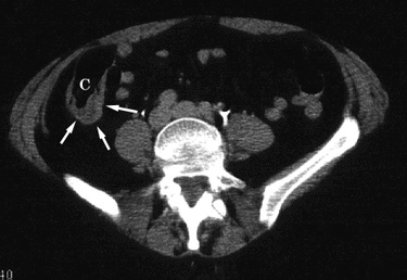 ct appendix
