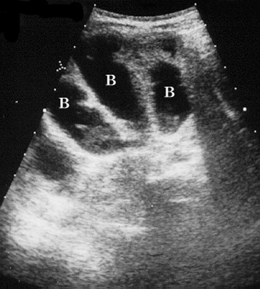 Mid Abdomen