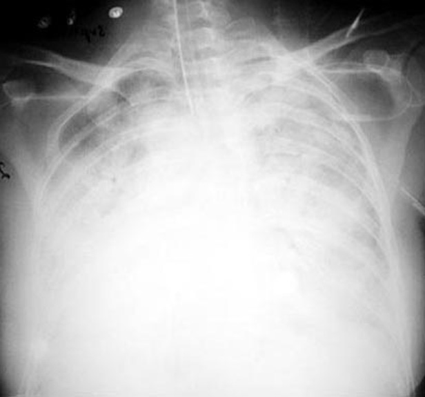 Ards Lung