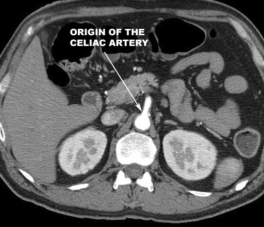 origin of celiac artery click the image for labeling