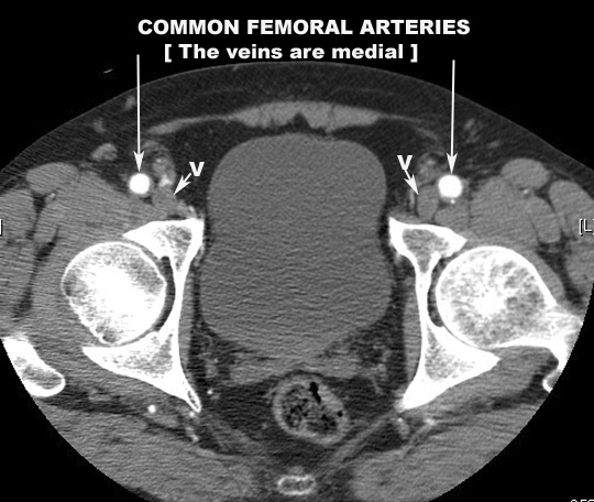 external iliac becomes the femoral artery click the image for labeling