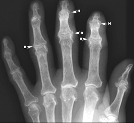  B: Bouchard nodes (osteophytes proximal interphalangeal joints) 