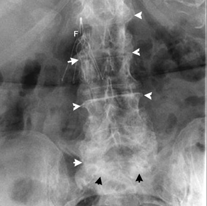 Spine Osteoarthritis