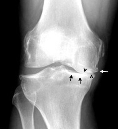 arthritis knee. Arthritis+knee