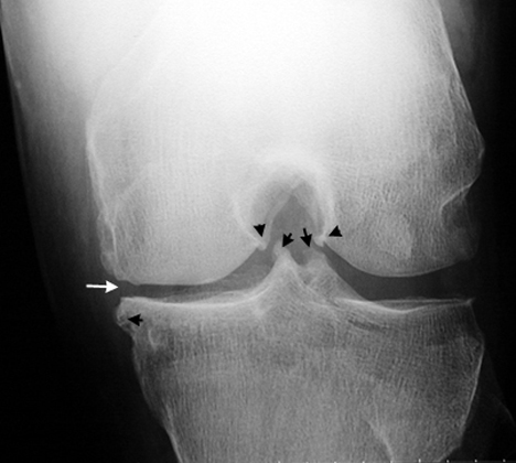 Osteoarthritis Of Knee. Osteoarthritis Knee