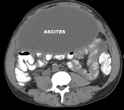 Ascites Ct