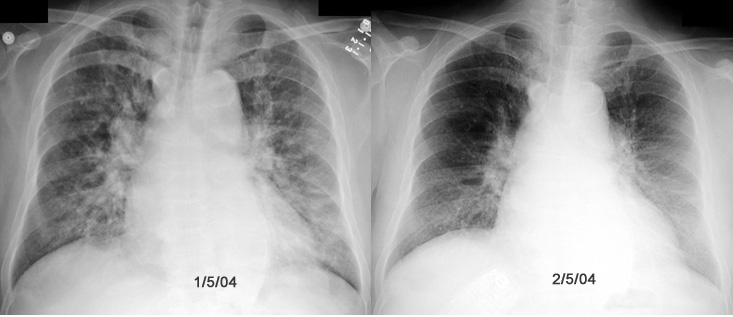 Q2: Anticipated findings in Chest x-ray in a patient with congestive heart 