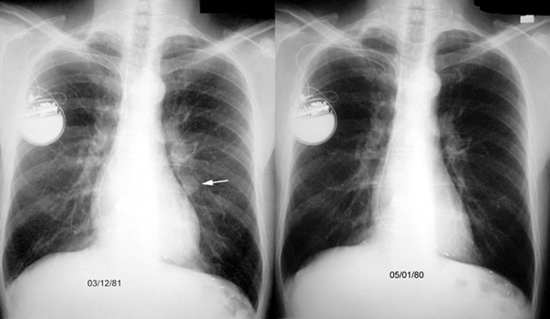 x rays of lung cancer. Adenocarcinoma Lung