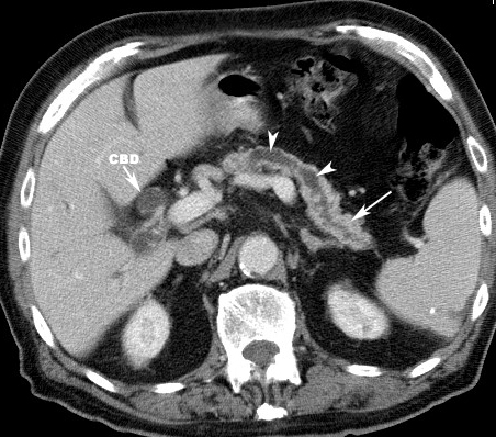 common bile duct obstruction. CBD: Dilated common bile duct