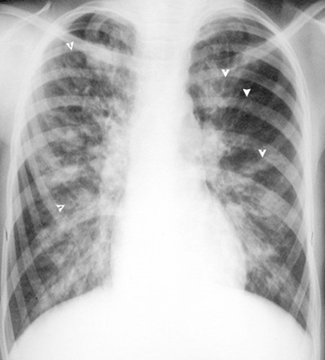 Bronchiectasis X Ray