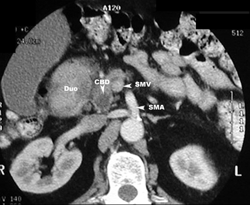 common bile duct obstruction. Dilated common bile duct