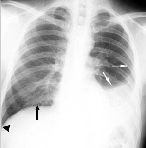 Urinothorax