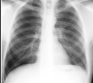 Urinothorax