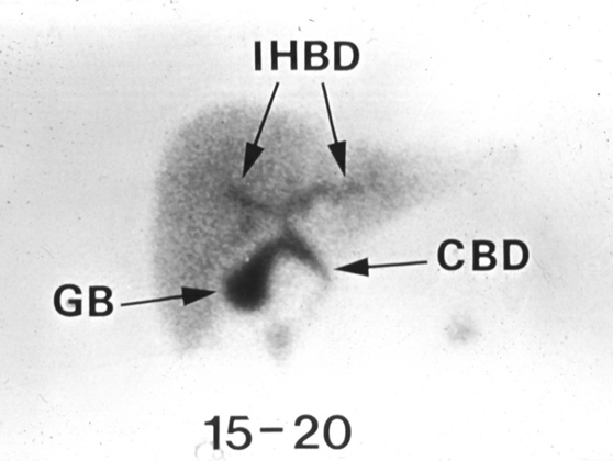 NORMAL HIDA SCAN