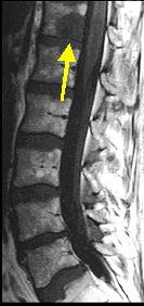 A: MRI (thoracic & lumbar) with and without contrast.