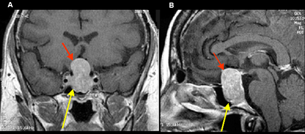 Brain Tumors