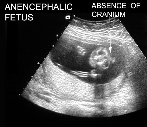 Anencephaly+Ultrasound+Pictures What are the imaging findings of anencephalic pregnancy?