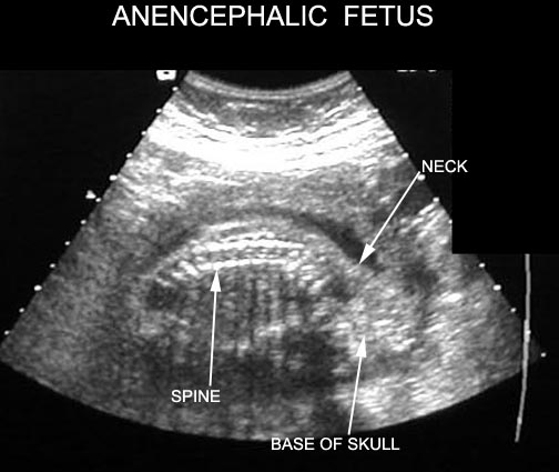 Anencephaly+Ultrasound+Pictures The fetus is evaluated by targeted ultrasound once the AFP levels are ...