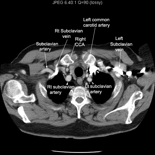 Common Carotid Artery