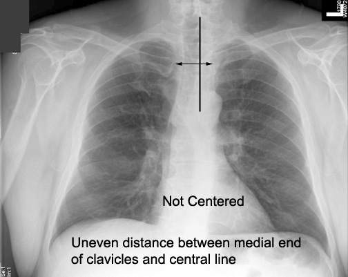Anatomy Of Chest Radiograph : Lateral Chest Radiograph Anatomy Page 1