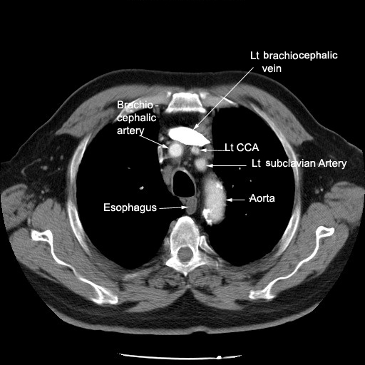 Thorax Radiologic Anatomy