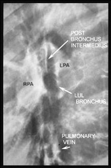 Image of Sarcoidosis - LATERAL CHEST RADIOGRAPH