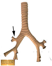 Trachea and Lungs Trachea and Lungs