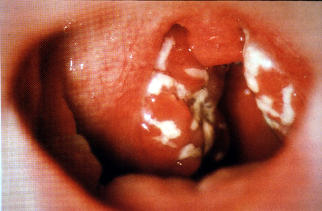 Group A beta-hemolytic streptococcus infection; Three day incubation period 