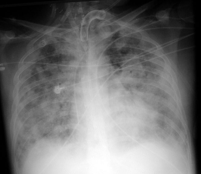 Cxr Ards