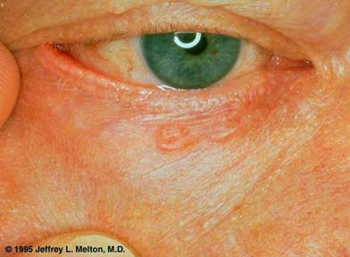 Nodular Basal Cell Carcinoma Of The Eyelid