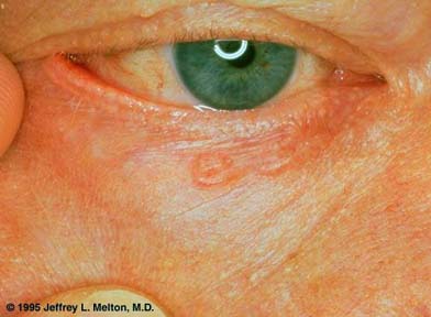 Basal Cell Carcinoma Eyelid