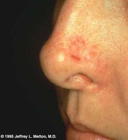 Recurrent Basal Cell Carcinoma Of The Nose