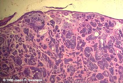 Basal Cell Carcinoma Histology