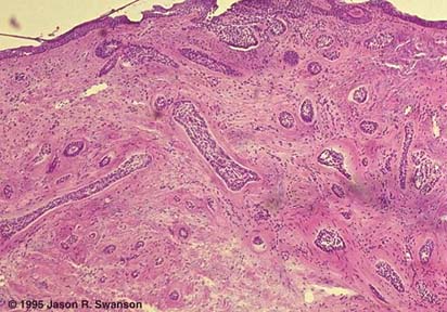 Histology Morpheaform Basal Cell Carcinoma